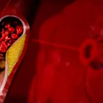 Tiché signály na koži, očiach a šľachách: Ako odhaliť vysoký cholesterol včas?